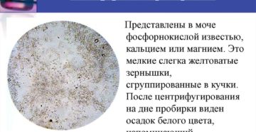 Аморфные фосфаты в моче