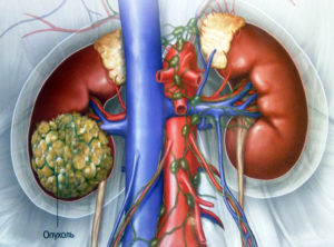 Как лечат рак почки