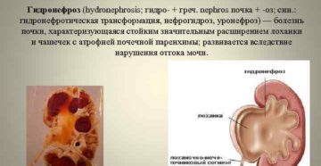 Как лечить пиелокаликоэктазия почки