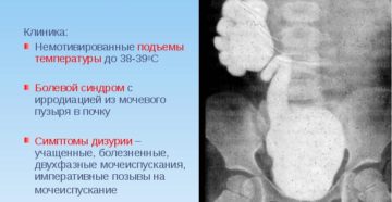 Рефлюкс почки у взрослых