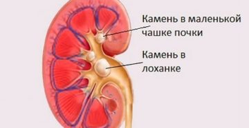 Камень в лоханке почки симптомы