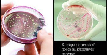 Кишечная палочка в мазке у женщин лечение