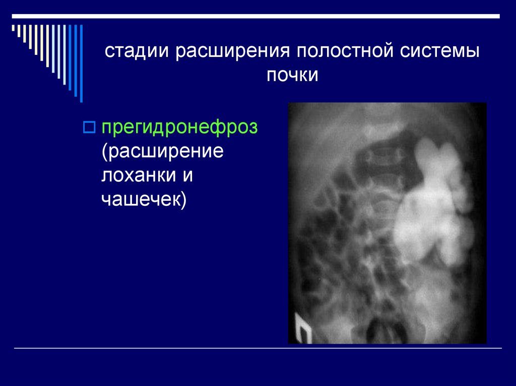 Расширение полостной системы левой почки