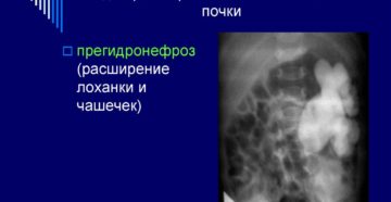 Расширение полостной системы левой почки