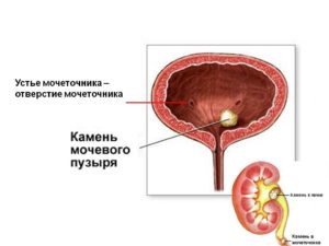 Устье левого мочеточника