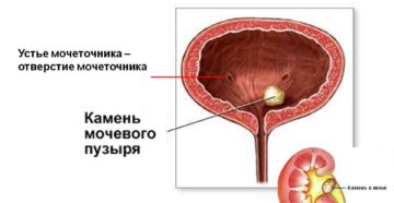 Устье левого мочеточника