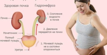 Гидронефроз почек у беременных