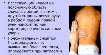 Положительный синдром пастернацкого