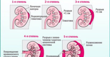Может ли болеть почка от поднятия тяжести