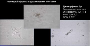 Как убрать эритроциты из мочи