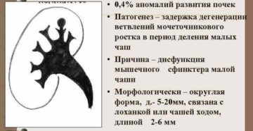 Дивертикул почки что это такое