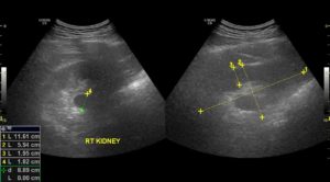 Узи почек уплотнена члс