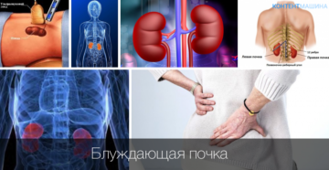 Блуждающая почка у ребенка симптомы