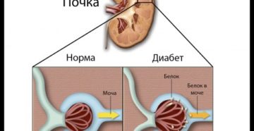Удаление почки при сахарном диабете