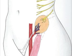 Воспаление нерва в паху с левой стороны