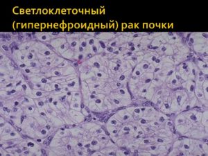 Гипернефроидный рак почки