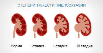 Пиелоэктазия почек что это такое