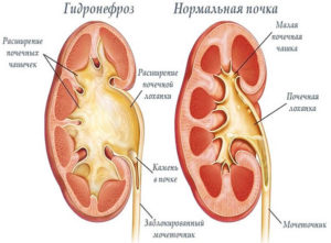 Расширения чашечек обеих почек и имвп