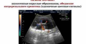 Что такое гидронефротическая трансформация левой почки