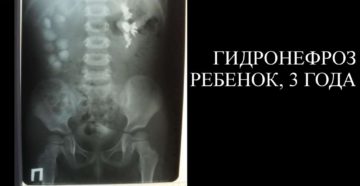 Гидронефроз почки у ребенка 3 лет