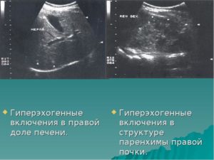 Члс обеих почек гиперэхогенные включения