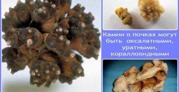 Что делать когда выходят камни из почек