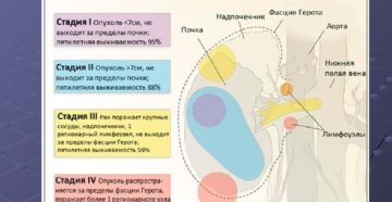 Скорость развития рака почки