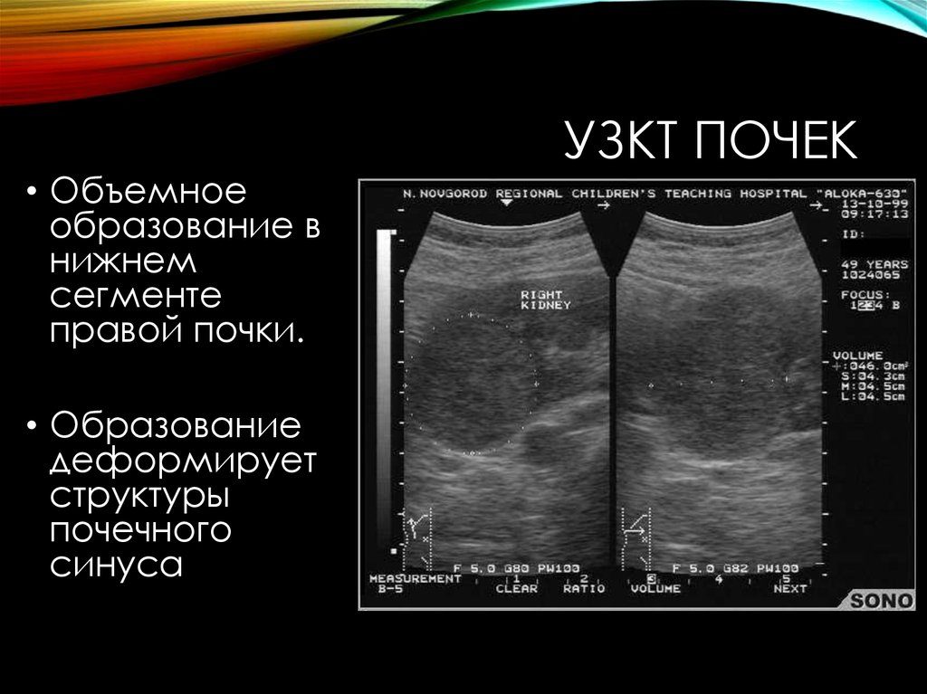 Признаки образования правой почки