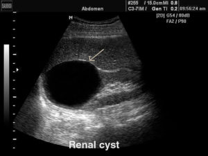 На узи киста на почке