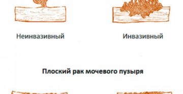 Неинвазивная папиллярная карцинома мочевого пузыря