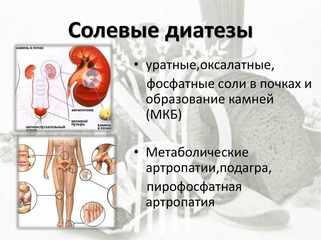 Солевой диатез почек диета