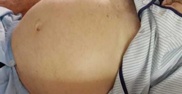Асцит брюшной полости при онкологии лечение народными средствами