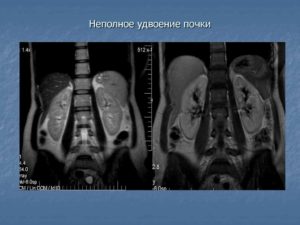 Неполное удвоение почки при беременности