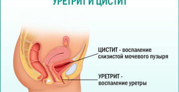 Цистит уретрит симптомы лечение