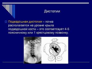 Почка на уровне подвздошной кости