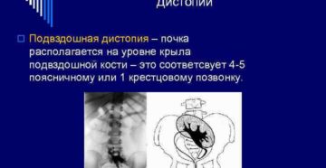 Почка на уровне подвздошной кости