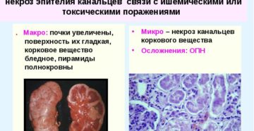 Острый некроз канальцев почек