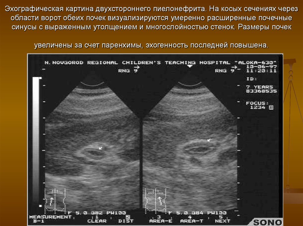 Воспаление почек можно ли увидеть на узи