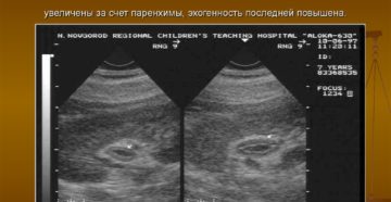 Воспаление почек можно ли увидеть на узи