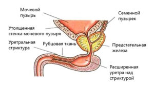 Сужение мочевого канала у мужчин лечение