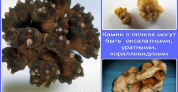 Что делать когда пошел камень в почках