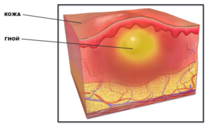 Почему образуется гной