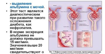 Микроальбуминурия что это