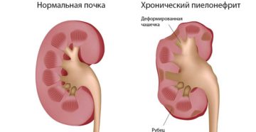 Передается ли пиелонефрит от женщины