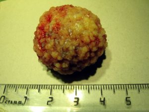 Камень в мочевом пузыре у мужчин лечение операция