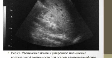 Почки средней эхогенности