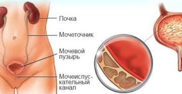 Боль в почках и мочевом пузыре