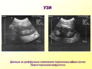 Структурные изменения почек на узи