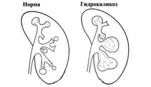 Каликоэктазия обеих почек при беременности