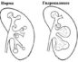 Каликоэктазия обеих почек при беременности